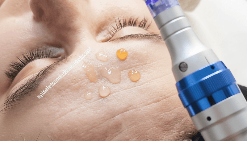 Microagulhamento Dermapen
